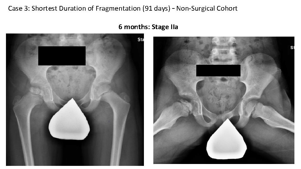 Case 3: Shortest Duration of Fragmentation (91 days) – Non-Surgical Cohort 6 months: Stage