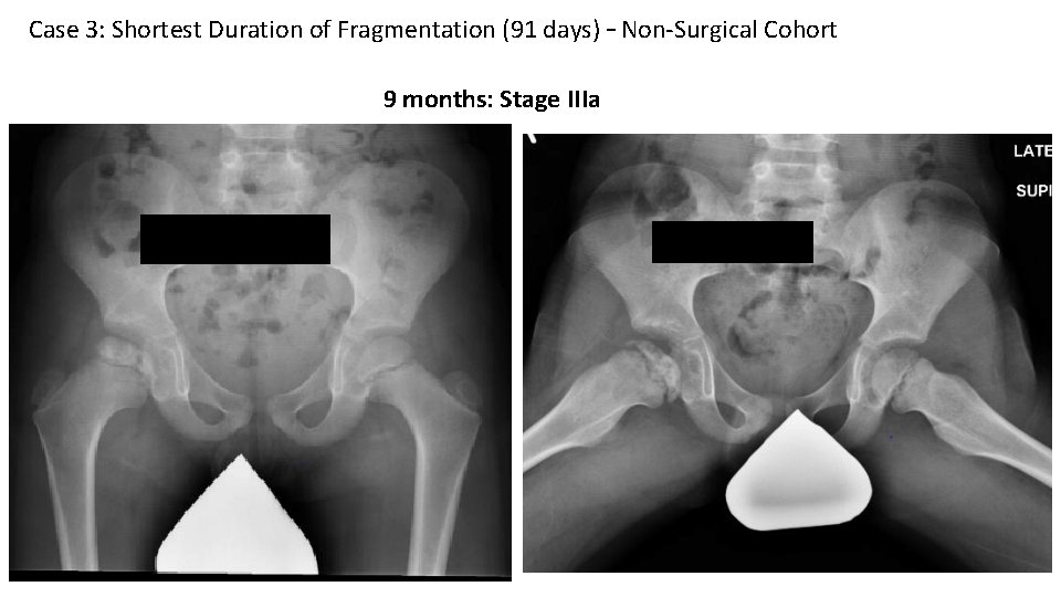 Case 3: Shortest Duration of Fragmentation (91 days) – Non-Surgical Cohort 9 months: Stage