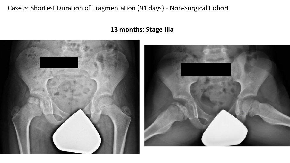 Case 3: Shortest Duration of Fragmentation (91 days) – Non-Surgical Cohort 13 months: Stage