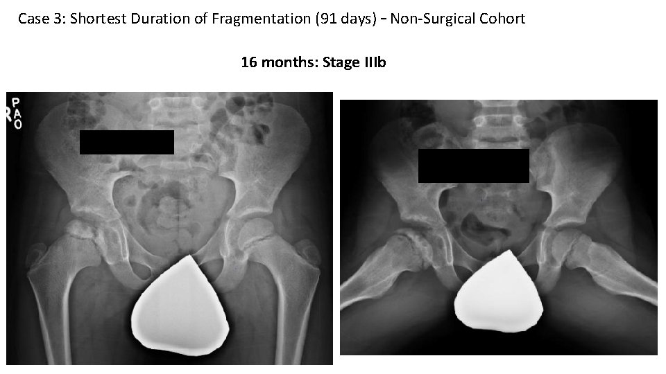 Case 3: Shortest Duration of Fragmentation (91 days) – Non-Surgical Cohort 16 months: Stage