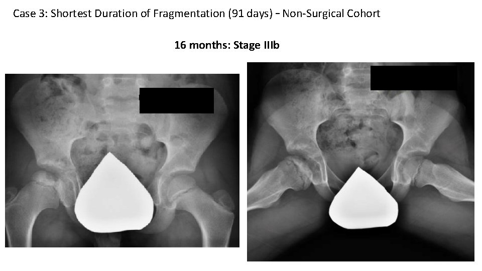 Case 3: Shortest Duration of Fragmentation (91 days) – Non-Surgical Cohort 16 months: Stage