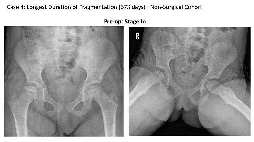 Case 4: Longest Duration of Fragmentation (373 days) – Non-Surgical Cohort Pre-op: Stage Ib
