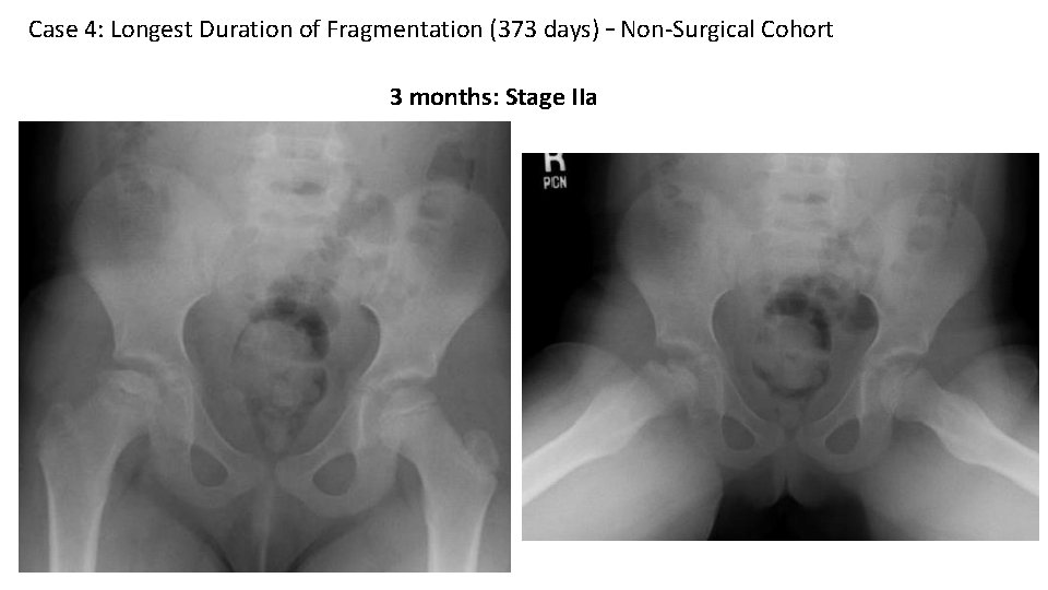 Case 4: Longest Duration of Fragmentation (373 days) – Non-Surgical Cohort 3 months: Stage