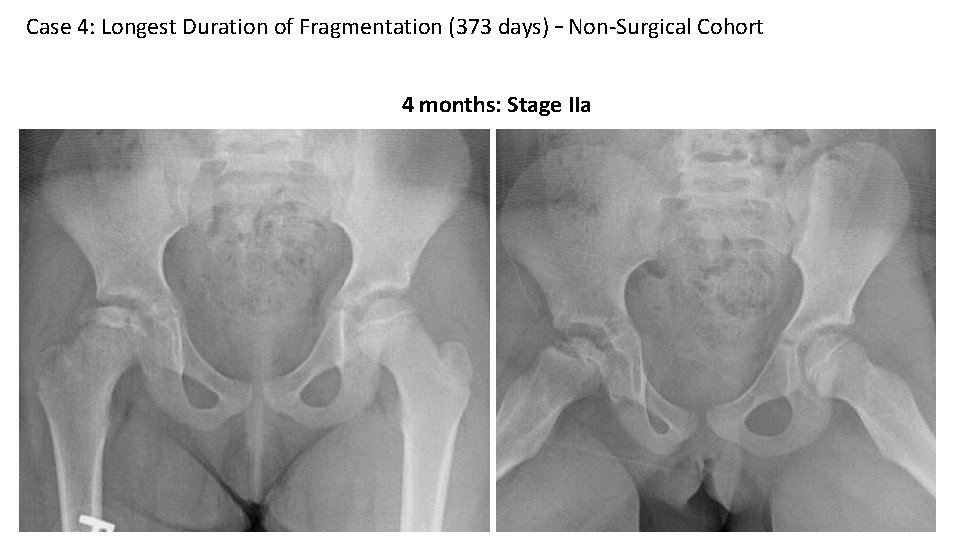 Case 4: Longest Duration of Fragmentation (373 days) – Non-Surgical Cohort 4 months: Stage