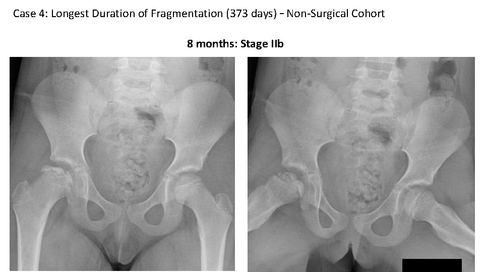 Case 4: Longest Duration of Fragmentation (373 days) – Non-Surgical Cohort 8 months: Stage