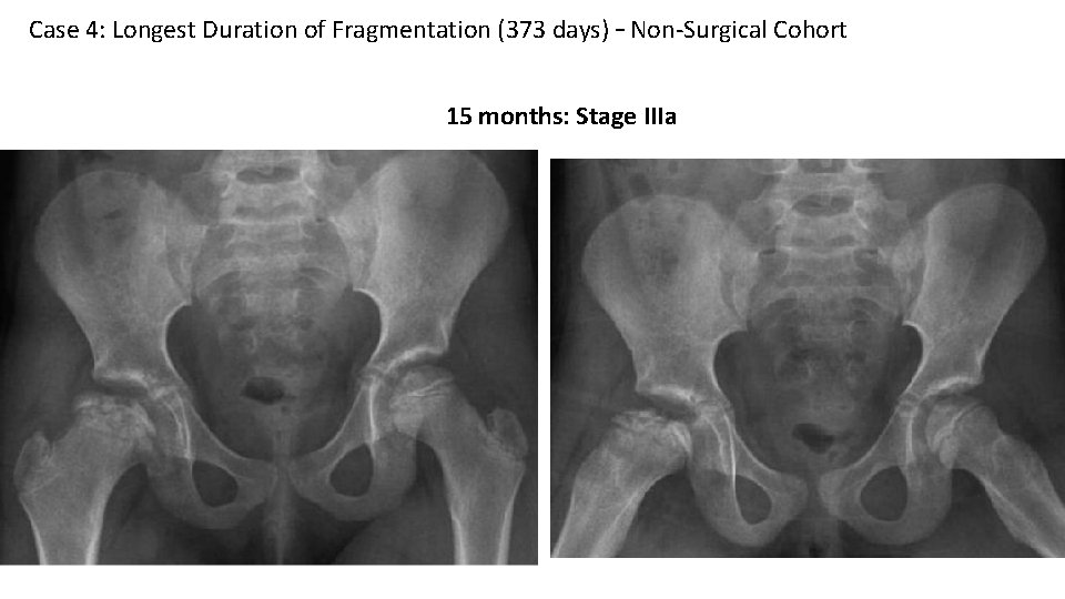 Case 4: Longest Duration of Fragmentation (373 days) – Non-Surgical Cohort 15 months: Stage