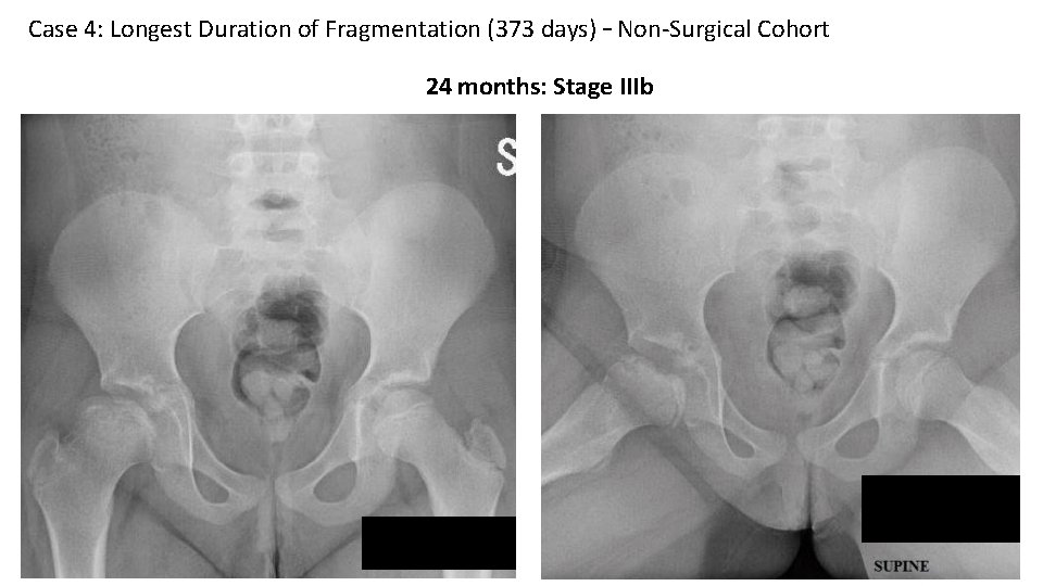 Case 4: Longest Duration of Fragmentation (373 days) – Non-Surgical Cohort 24 months: Stage