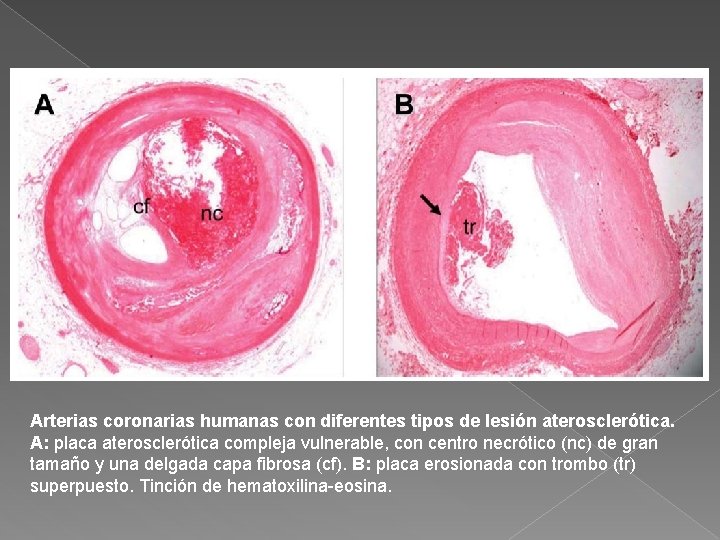 Arterias coronarias humanas con diferentes tipos de lesión aterosclerótica. A: placa aterosclerótica compleja vulnerable,