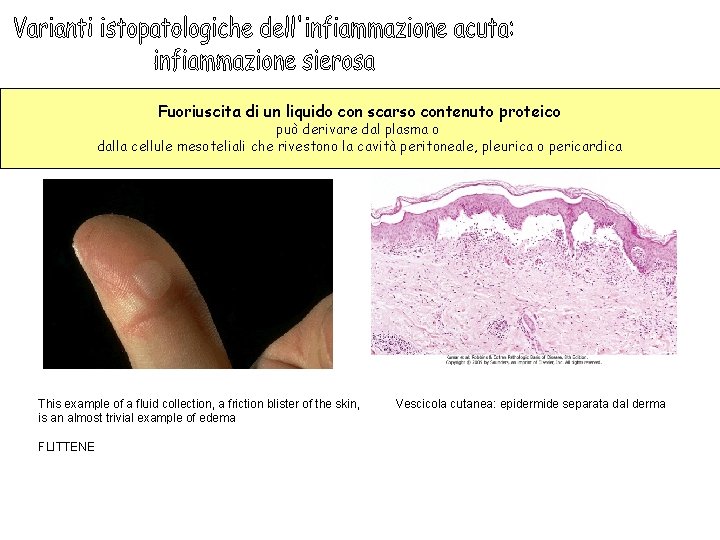 Fuoriuscita di un liquido con scarso contenuto proteico può derivare dal plasma o dalla