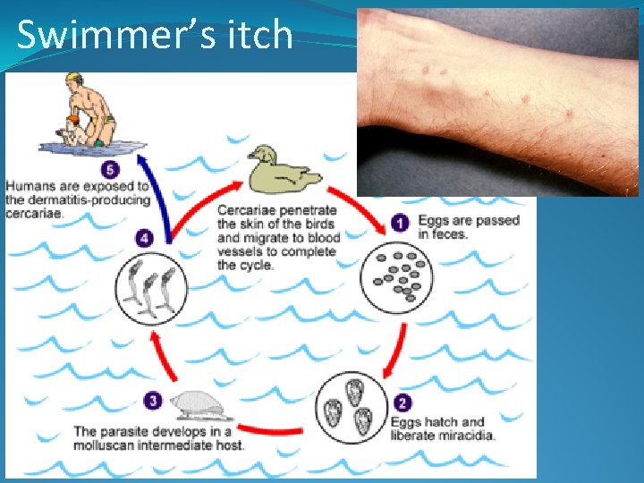 Swimmer’s itch 