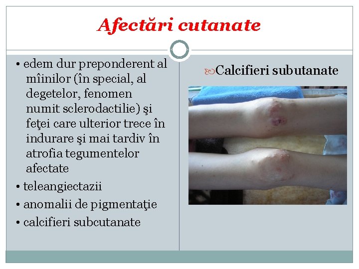 Afectări cutanate • edem dur preponderent al mîinilor (în special, al degetelor, fenomen numit