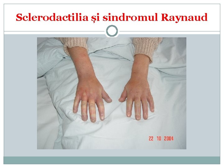Sclerodactilia și sindromul Raynaud 