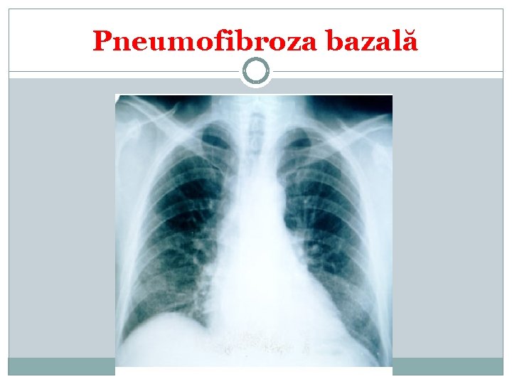 Pneumofibroza bazală 