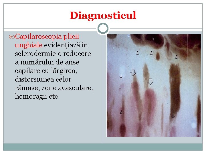 Diagnosticul Capilaroscopia plicii unghiale evidenţiază în sclerodermie o reducere a numărului de anse capilare