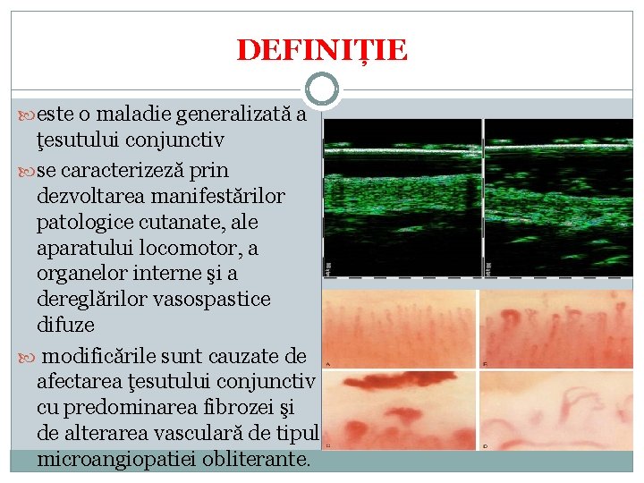 DEFINIȚIE este o maladie generalizată a ţesutului conjunctiv se caracterizeză prin dezvoltarea manifestărilor patologice