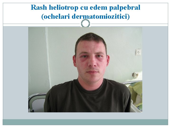 Rash heliotrop cu edem palpebral (ochelari dermatomiozitici) 
