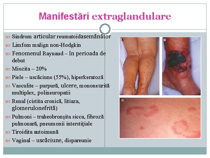 Manifestări extraglandulare Sindrom articular reumatoidasemănător Limfom malign non-Hodgkin Fenomenul Raynaud – în perioada de