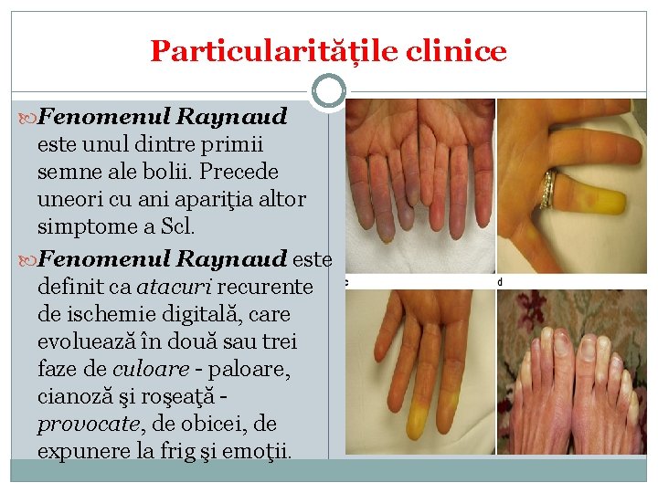 Particularitățile clinice Fenomenul Raynaud este unul dintre primii semne ale bolii. Precede uneori cu