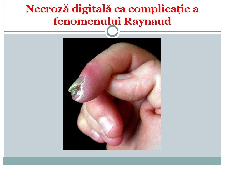 Necroză digitală ca complicație a fenomenului Raynaud 