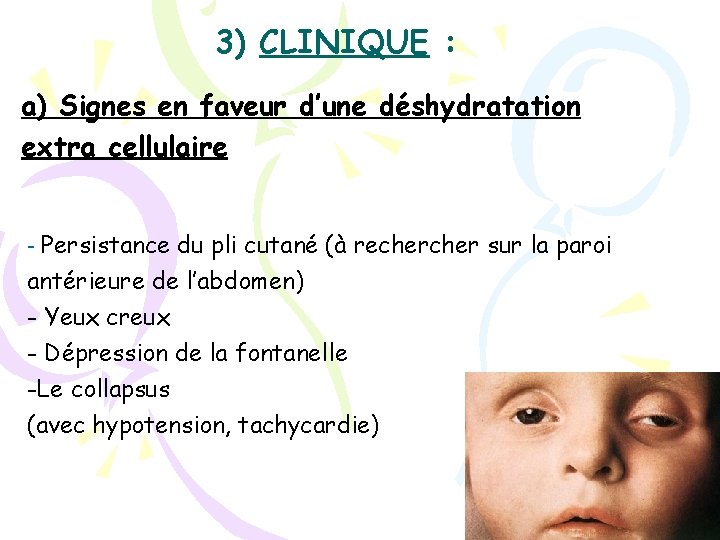 3) CLINIQUE : a) Signes en faveur d’une déshydratation extra cellulaire - Persistance du