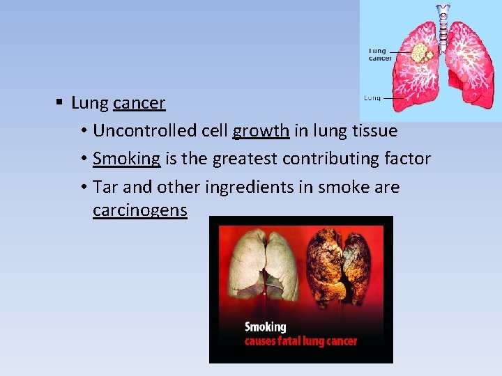 § Lung cancer • Uncontrolled cell growth in lung tissue • Smoking is the