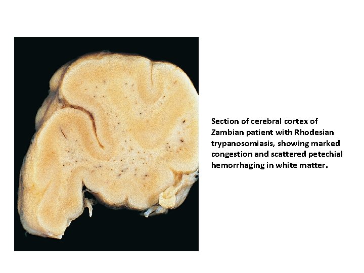 Section of cerebral cortex of Zambian patient with Rhodesian trypanosomiasis, showing marked congestion and