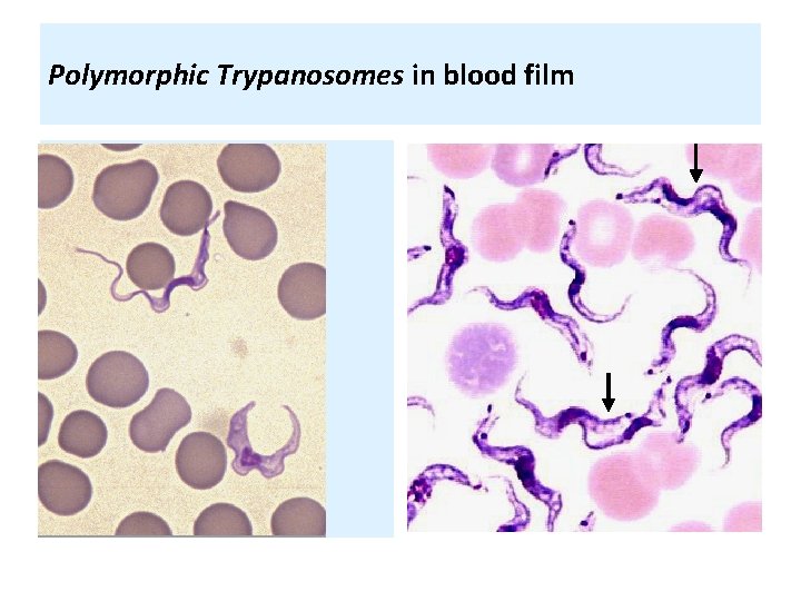 Polymorphic Trypanosomes in blood film 