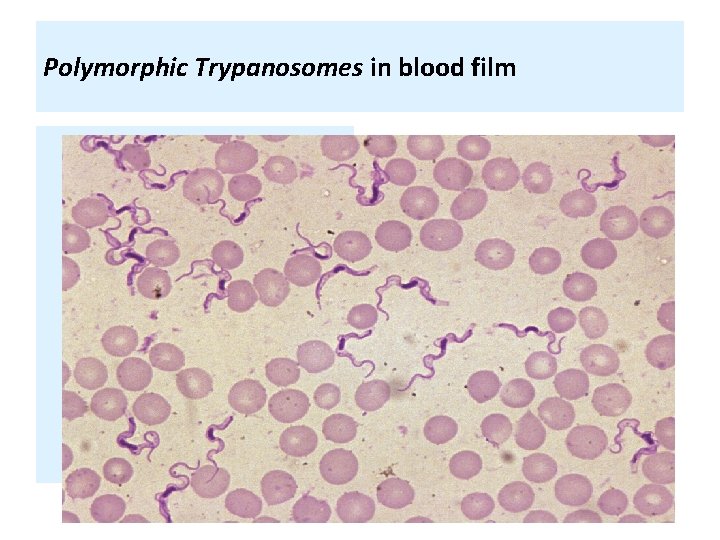 Polymorphic Trypanosomes in blood film 
