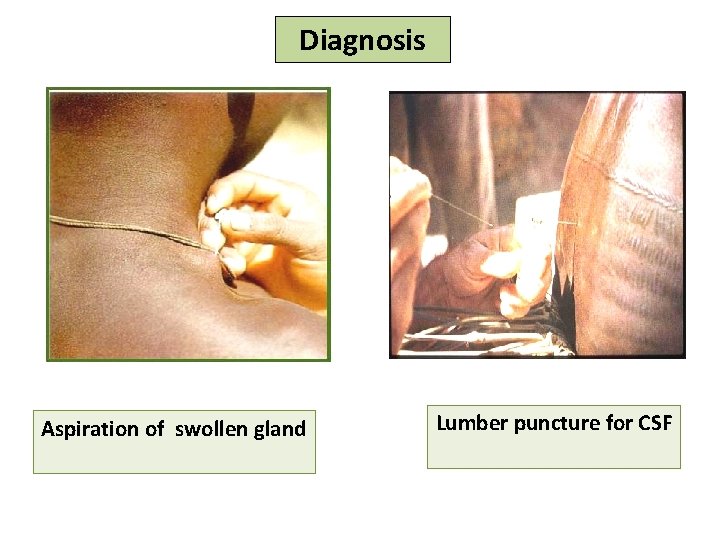 Diagnosis Aspiration of swollen gland Lumber puncture for CSF 