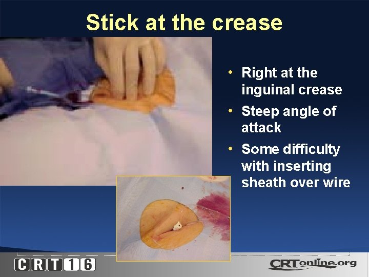 Stick at the crease • Right at the inguinal crease • Steep angle of