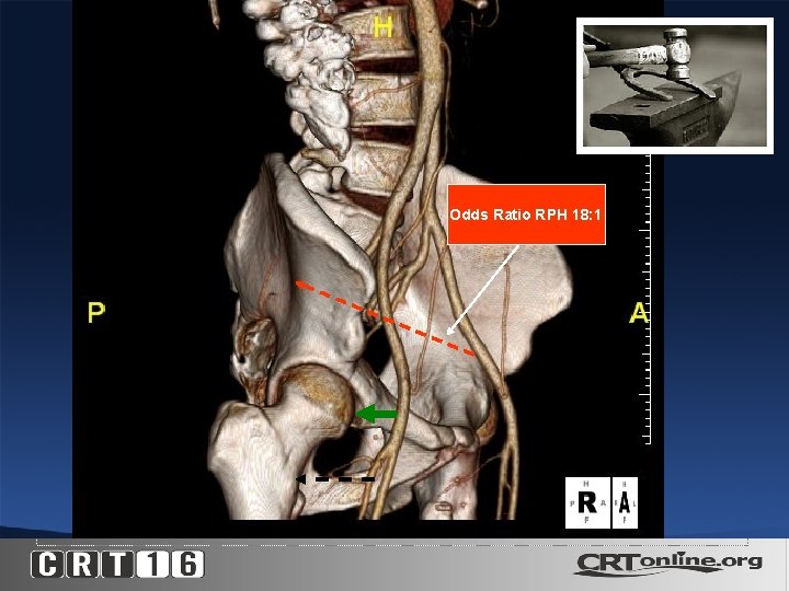 Odds Ratio RPH 18: 1 