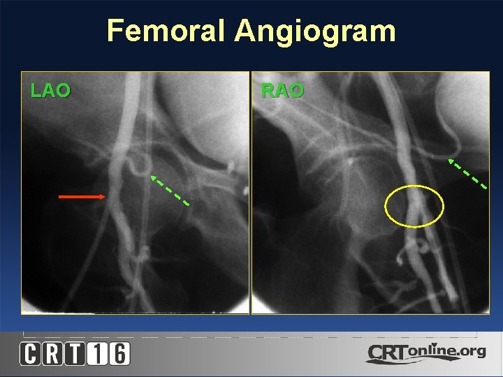 Femoral Angiogram LAO RAO 