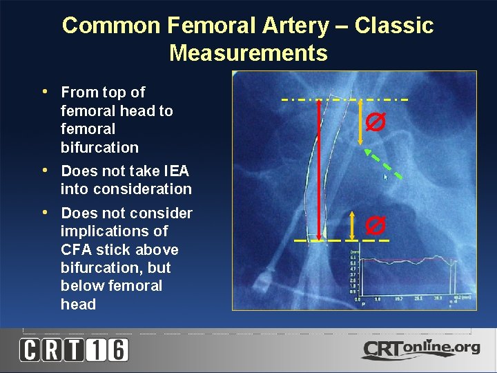 Common Femoral Artery – Classic Measurements • From top of femoral head to femoral