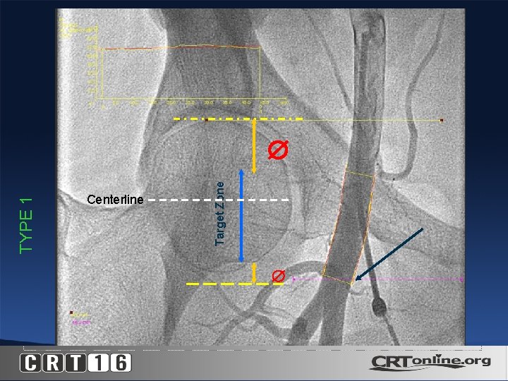 TYPE 1 Centerline Target Zone 