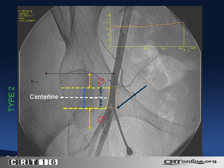 TYPE 2 Centerline Target Zone 