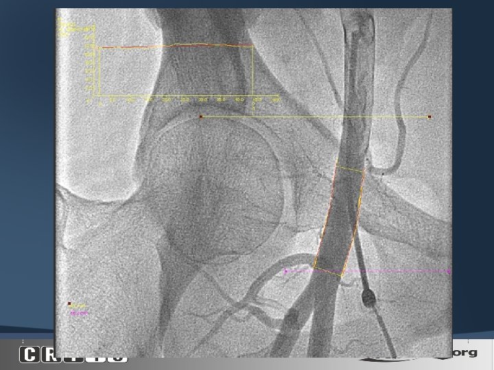  IEA FH Centerline Cumulative Target Zone BIF 