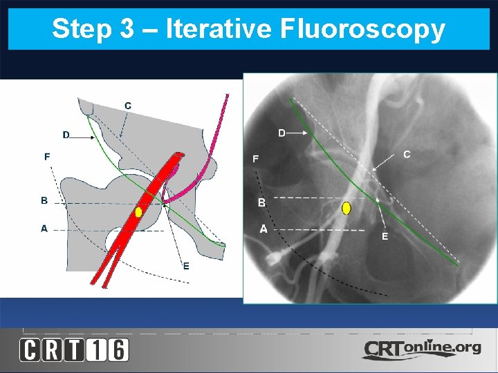 Step 3 – Iterative Fluoroscopy 