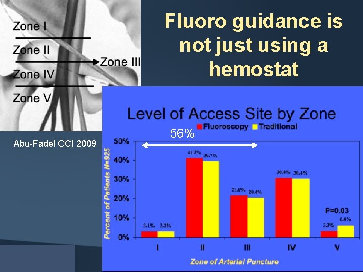 Fluoro guidance is not just using a hemostat Abu-Fadel CCI 2009 56% 
