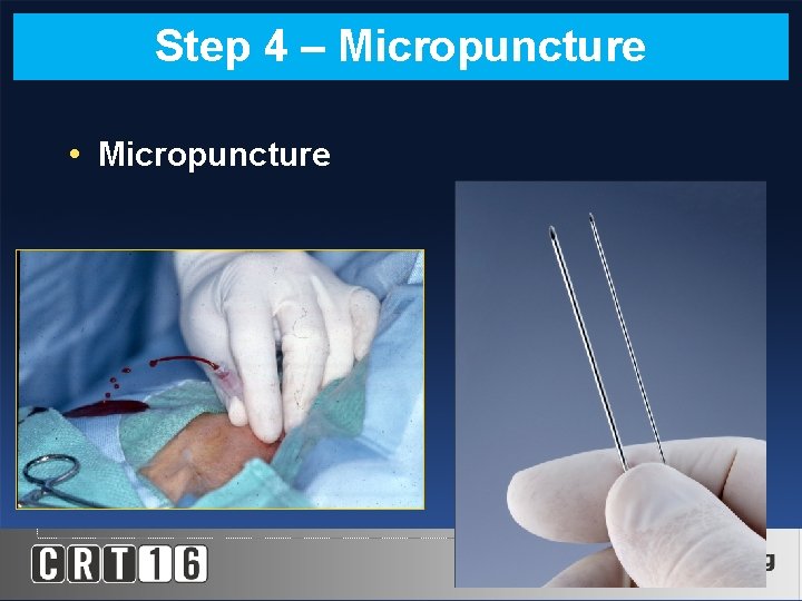 Step 4 – Micropuncture • Micropuncture 