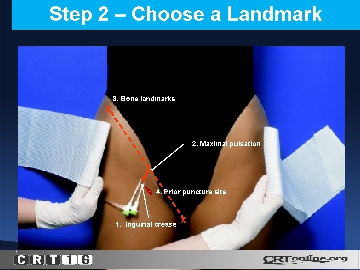 Step 2 – Choose a Landmark 3. Bone landmarks X 2. Maximal pulsation 4.