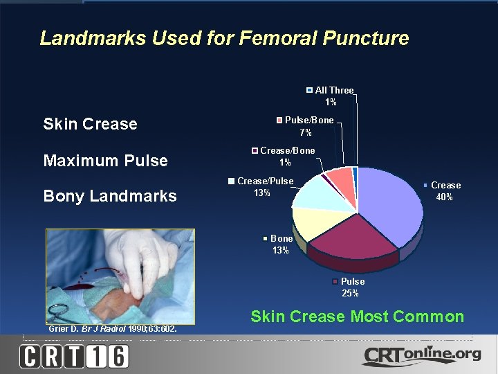 Landmarks Used for Femoral Puncture All Three 1% Skin Crease Maximum Pulse Bony Landmarks