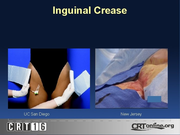 Inguinal Crease UC San Diego New Jersey 