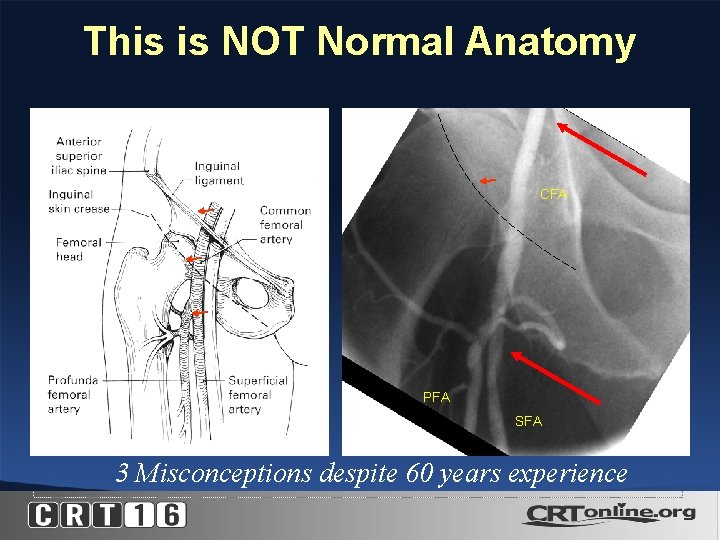 This is NOT Normal Anatomy CFA PFA SFA 3 Misconceptions despite 60 years experience