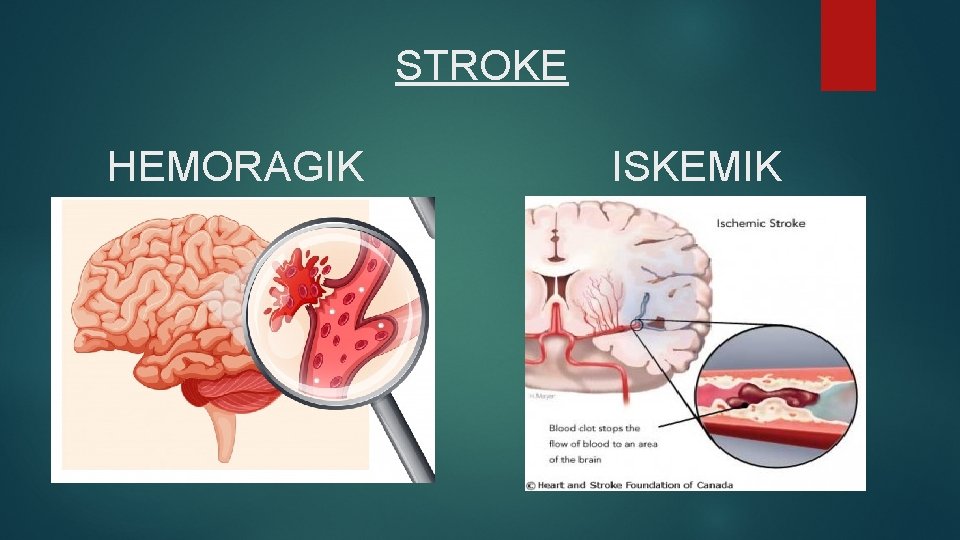 STROKE HEMORAGIK ISKEMIK 