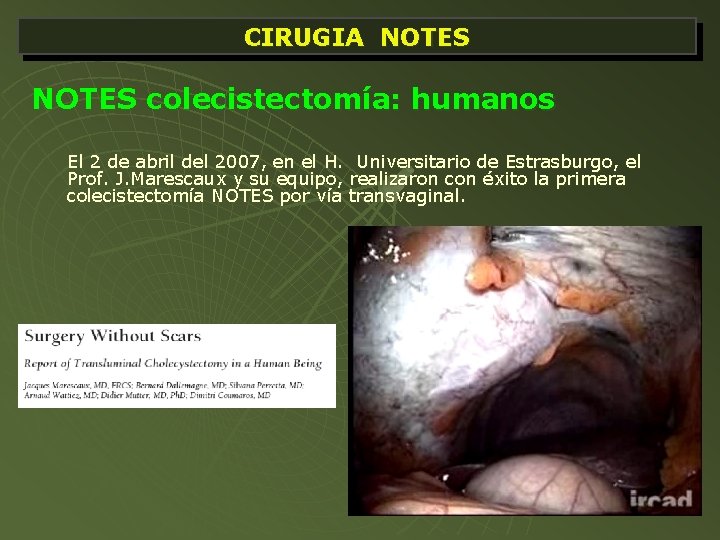 CIRUGIA NOTES colecistectomía: humanos El 2 de abril del 2007, en el H. Universitario