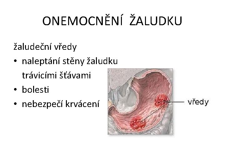 ONEMOCNĚNÍ ŽALUDKU žaludeční vředy • naleptání stěny žaludku trávicími šťávami • bolesti • nebezpečí