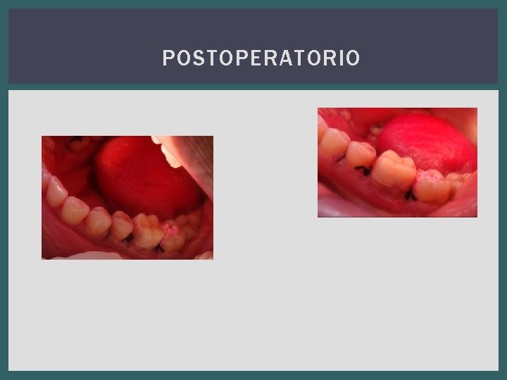 POSTOPERATORIO 