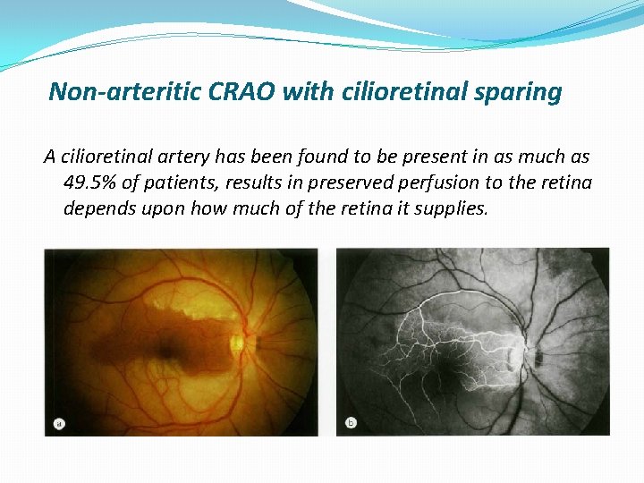 Non-arteritic CRAO with cilioretinal sparing A cilioretinal artery has been found to be present