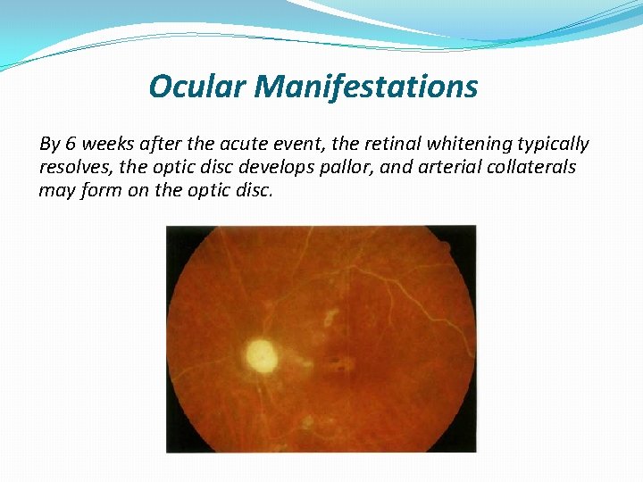 Ocular Manifestations By 6 weeks after the acute event, the retinal whitening typically resolves,