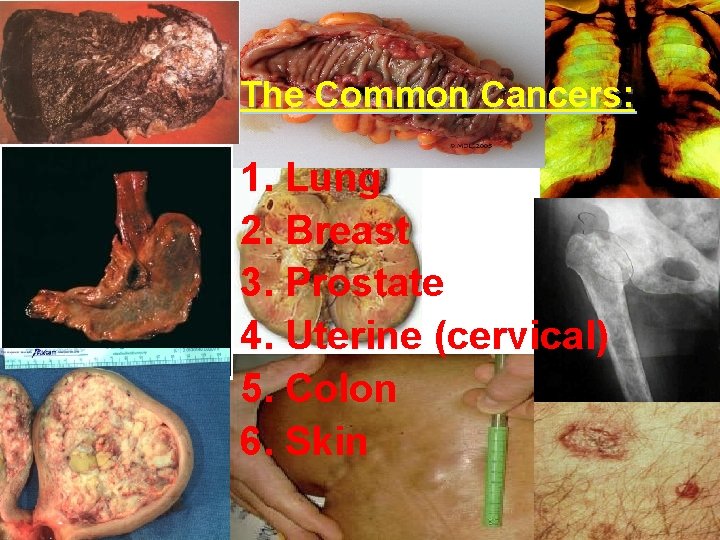 The Common Cancers: 1. Lung 2. Breast 3. Prostate 4. Uterine (cervical) 5. Colon